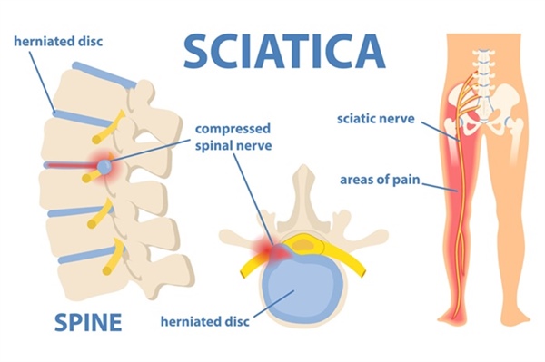 Chiropractic Care for Sciatica: Does It Work?